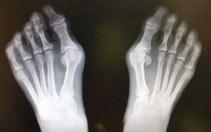 bunion hallux valgus, arthritis of the big toe joint