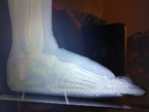Top Of The Foot Arthritis 3 Swelling on Top of the foot spur and arthritis pain