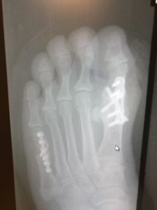 Great Toe Joint Fusion Surgery 4 Big Toe Joint Fusion Recovery Time