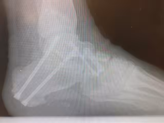 Flat Foot Surgery Pros and Cons