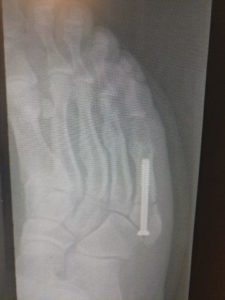 Oblique view Jones fracture 5th metatarsal broken bone recovery time