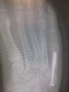 AP view percutaneous jones fracture reduction surgery recovery time