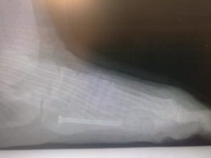 Lateral view of 5th metatarsal or jones fracture percutaneous surgery