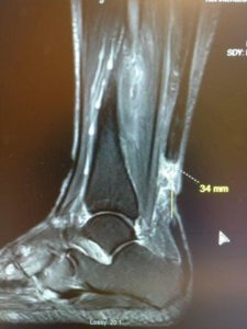 Achilles Tendon Tear From chronic achilles tendonitis