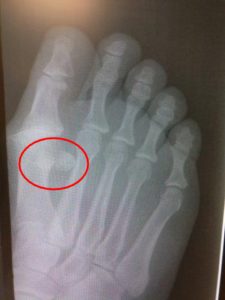 Bipartite sesamoid, fractured sesamoid treatment