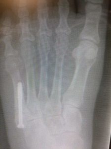 Jones Fracture Percutaneous open reduction internal fixation recovery time.