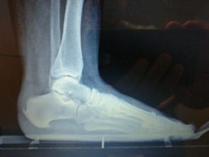 bottom of the heel spur from plantar fascia heel pain