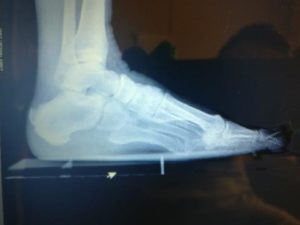 Achilles tendonitis insertional heel spur back of the heel spur