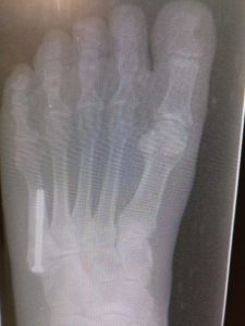 Jones fracture healing time percutaneous screw fixation