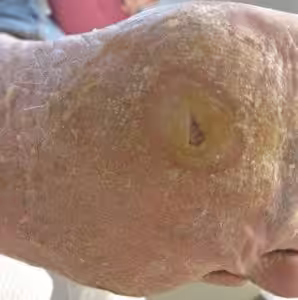 Stone Bruise on the bottom of the foot recovery time.