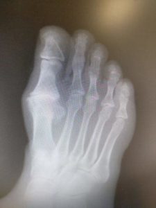 Hallux rigidus best treatment, inserts, exercises