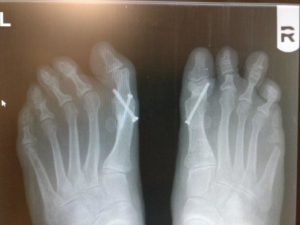 bilateral big toe joint fusion for halllux rigidus bunion