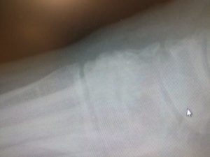 Top Of The Foot Arthritis 2 Top Of The Foot Arthritis: Causes, Symptoms & Best Treatment 2020