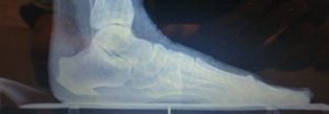 Stone Bruise 1 stone bruise on heel and foot treatment
