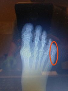 Broken 5th toe vs sprained 5th toe