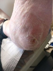 early staph infection on heel and foot