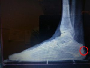 Achilles tendon bone spur back of the heel spur