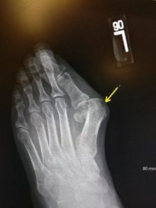 severe bunion hallux valgus