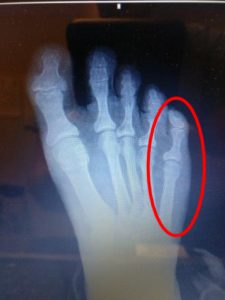 Sprained Pinky Toe Pain or Broken Pinky Toe? Best Treatment 2019