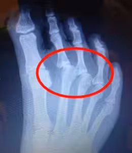 2nd toe predislocation syndrome and 2nd toe dislocation plantar plate rupture