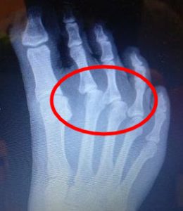 2nd toe predislocation syndrome and 2nd toe dislocation plantar plate rupture