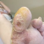 Staph infection on big toe or foot