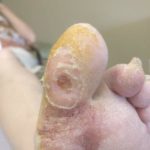 Staph infection on big toe or foot