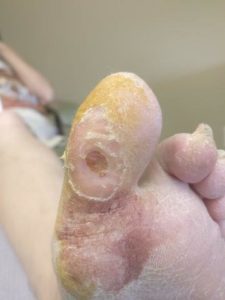 Staph infection on big toe or foot