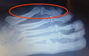 Sharp and Shooting Pain in the Little Toe 8 Foot Pain Along the Outside of the Foot causes