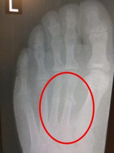 Metatarsal stress fracture foot stress fracture