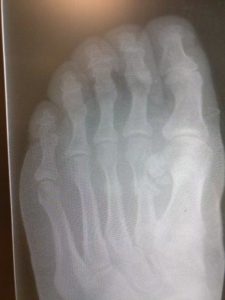 Metatarsal fracture of the 2nd metatarsal