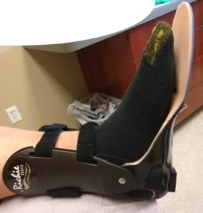 Ankle foot orthosis for broken ankle rehabilitation