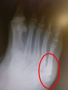 Jones Fracture Healing time and recovery time