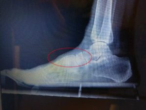 Bone spur on top of the middle of the foot lisfranc joint