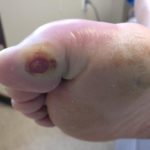 big toe joint ulcer and big toe joint wound