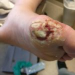 Staph infection of the big toe & staph infection of the foot