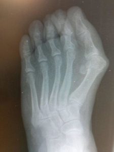 huge bunion deformity hallux abducto valgus