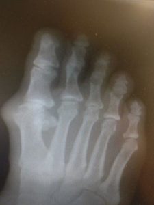 Big toe joint arthritis hallux rigidus