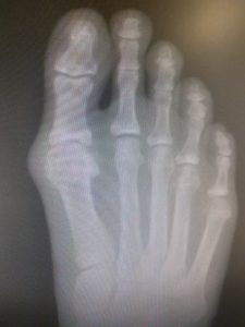 big toe joint arthritis of the big toe joint great toe