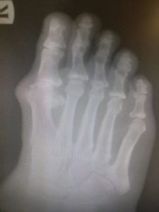 Big toe joint arthritis hallux rigidus bone spur