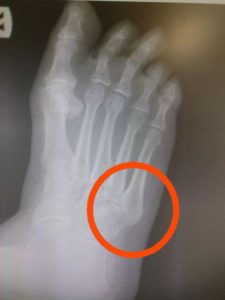 5th metatarsal styloid process pain