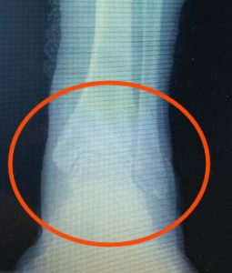 Signs of Broken Ankle Vs Sprained Ankle 3 Broken Ankle Anatomy Recovery Time