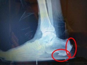 Achilles tendonitis insertional heel spur surgery recovery time