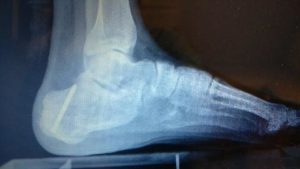 Calcaneus Foot Pain 7 calcaneus heel fracture trauma