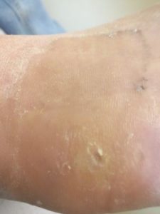 Heloma durum on the foot home treatment