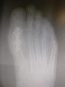 Pros and Cons 1st MTPJ metatarsal phalangeal joint fusion of the big toe joint
