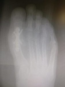 Big Toe Joint Fusion 9 Pros and Cons 1st MTPJ metatarsal phalangeal joint fusion of the big toe joint