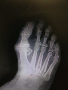Big toe joint arthritis and hallux rigidus treatment