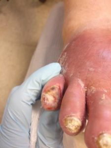 Open wound with a broken pinky toe.
