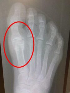 Hallux rigidus big toe joint arthritis